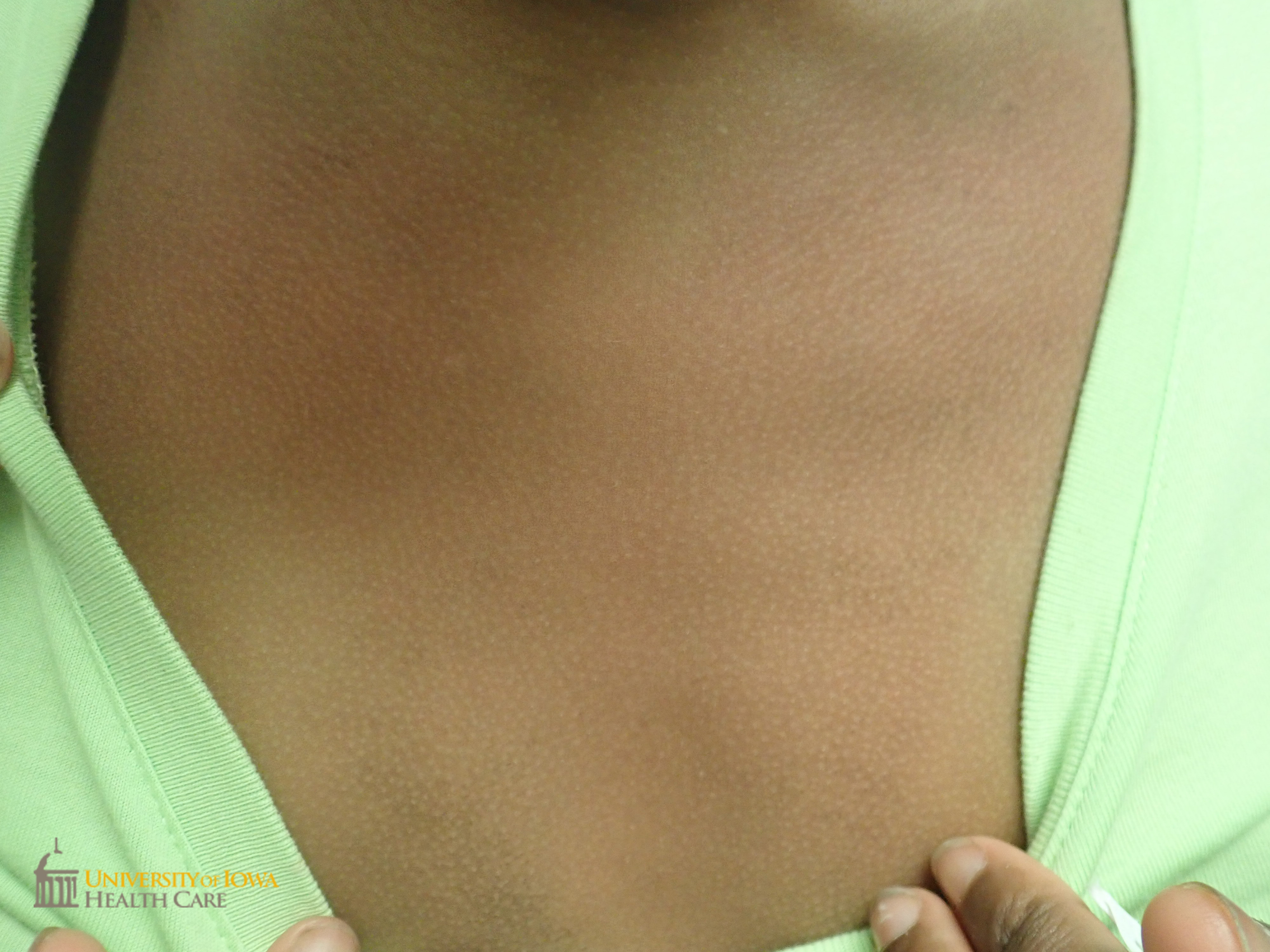 Resolution of brown patch after alcohol swab. (click images for higher resolution).